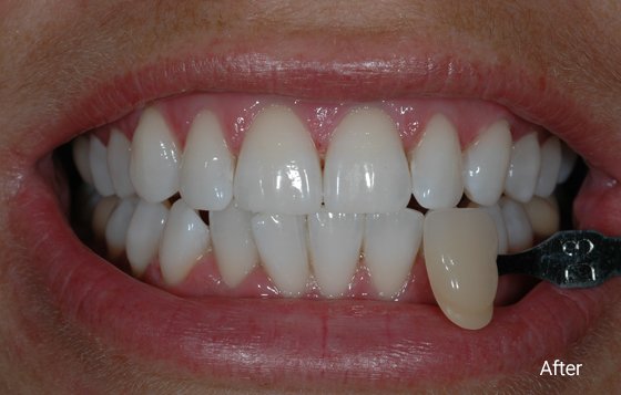 after teeth whitening 1