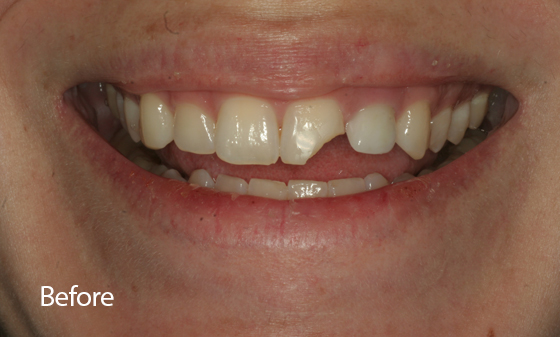 Composite Bonding Case before 1