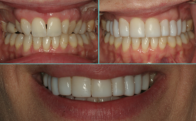 Full upper set of bonding reshaping the smile and face