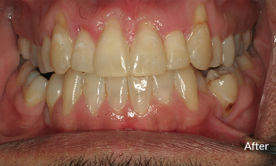 gap teeth fixed with invisalign after