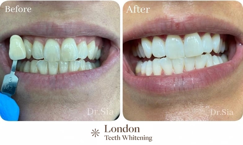 porcelain veneers before after 5