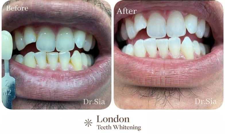 porcelain veneers before after 7