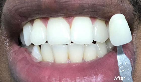 after teeth whitening