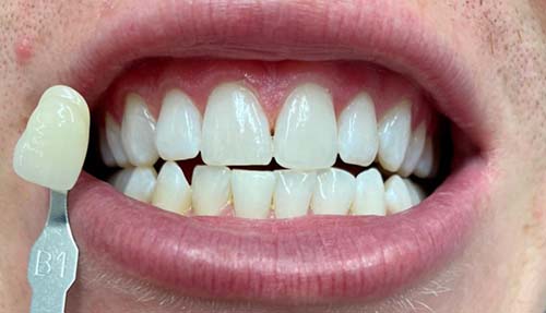 Porcelain Veneers After 1