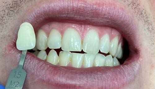 Porcelain Veneers before 1