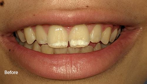 white spot treatment. ICON therapy before invisalign